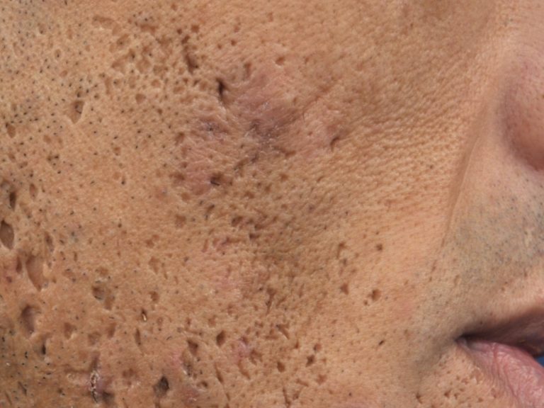 Acne Scar Removal Baltimore