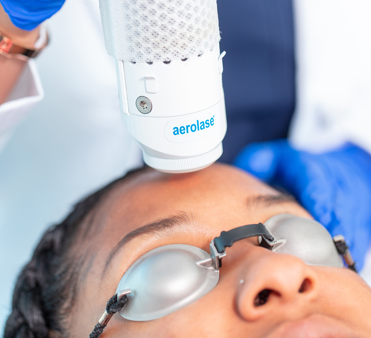 NeoClear Aerolase Acne Therapy Baltimore