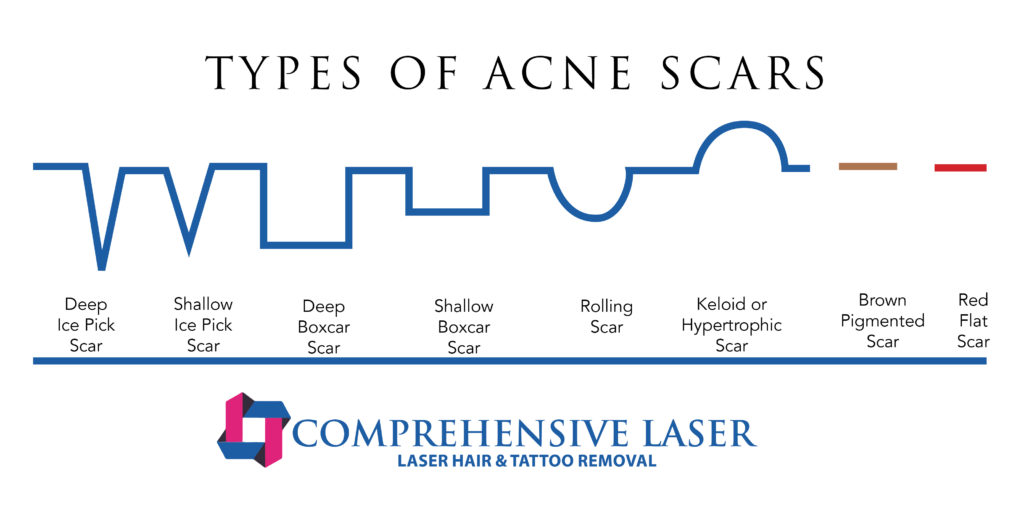 acne scar infographic