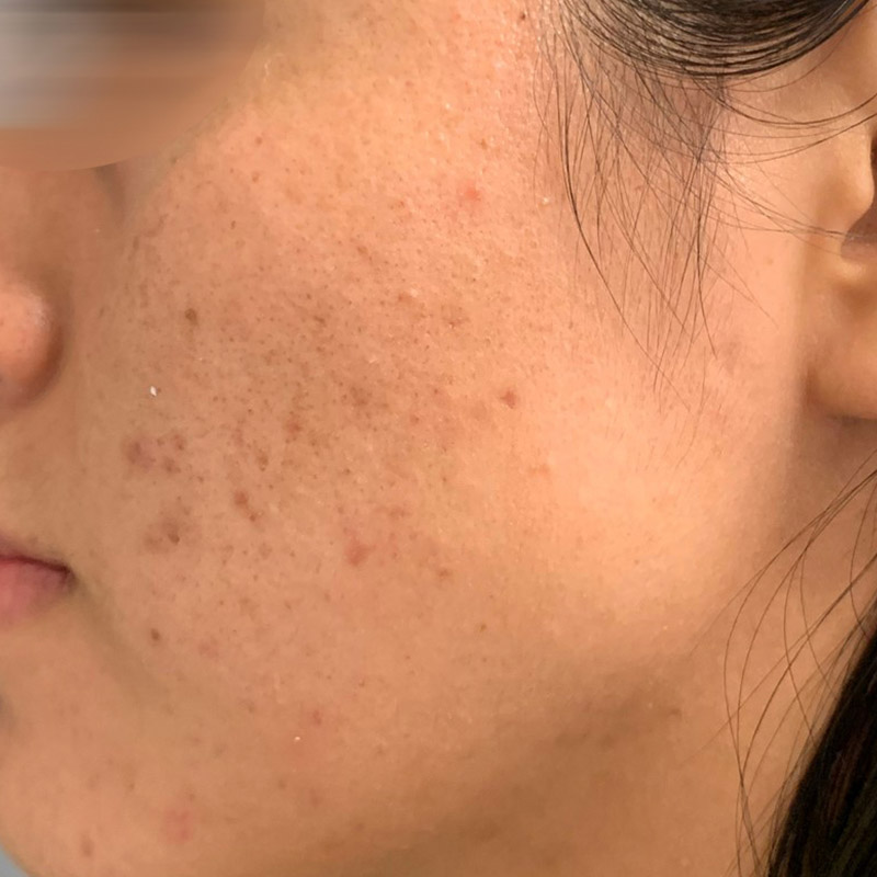 Chemical Peel Before and After | Comprehensive Laser & Aesthetics