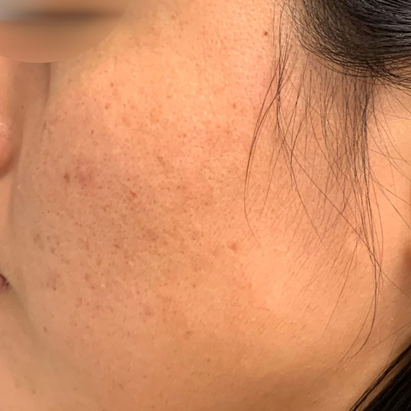 Chemical Peel Before and After | Comprehensive Laser & Aesthetics