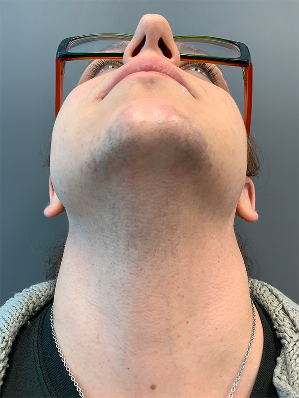Laser Hair Removal Before and After | Comprehensive Laser & Aesthetics