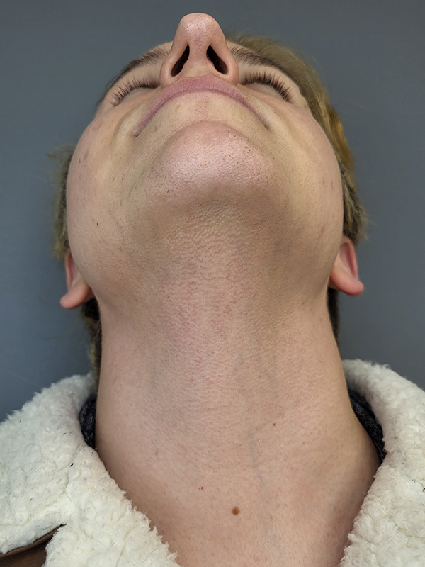 Laser Hair Removal Before and After | Comprehensive Laser & Aesthetics