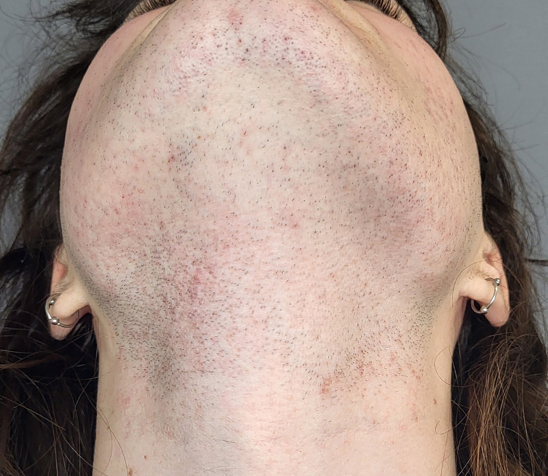 Laser Hair Removal Before and After | Comprehensive Laser & Aesthetics