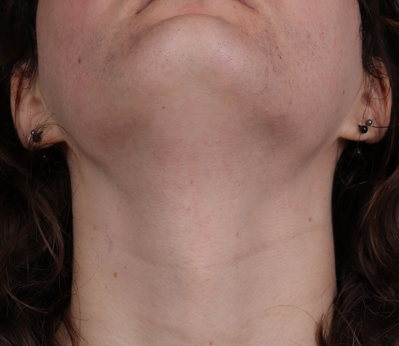 Laser Hair Removal Before and After | Comprehensive Laser & Aesthetics