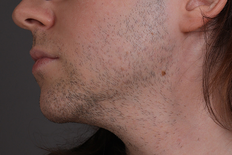 Laser Hair Removal Before and After | Comprehensive Laser & Aesthetics