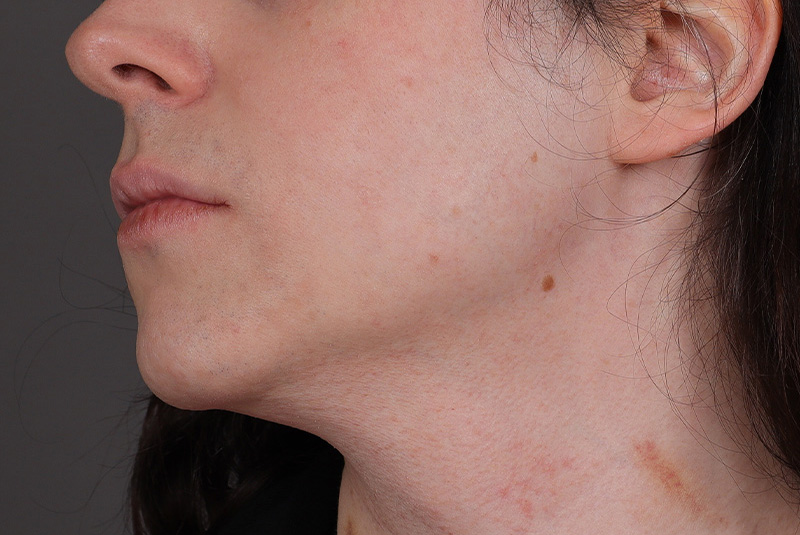 Laser Hair Removal Before and After | Comprehensive Laser & Aesthetics