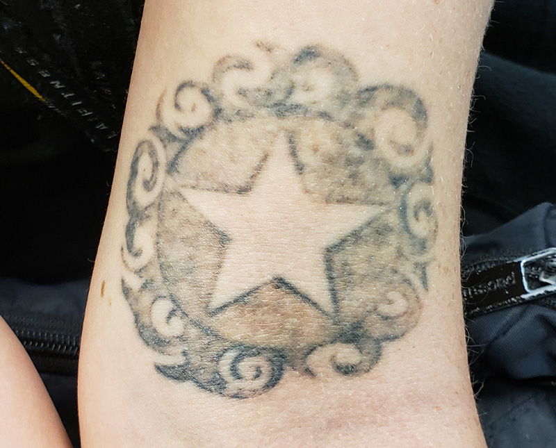 Laser Tattoo Removal Before and After | Comprehensive Laser & Aesthetics