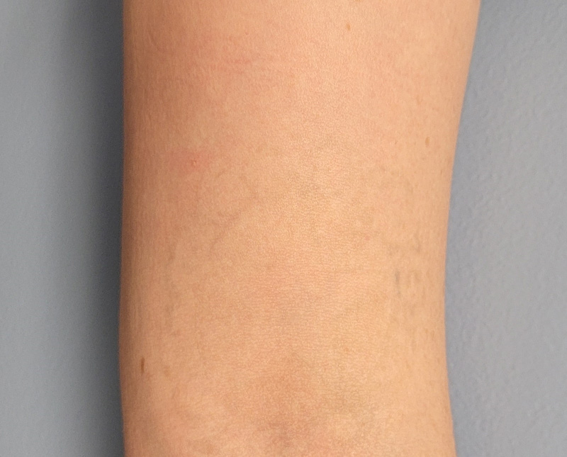 Laser Tattoo Removal Before and After | Comprehensive Laser & Aesthetics