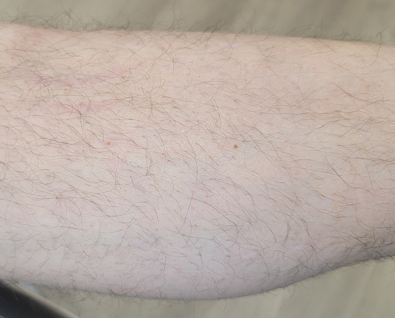Laser Tattoo Removal Before and After | Comprehensive Laser & Aesthetics