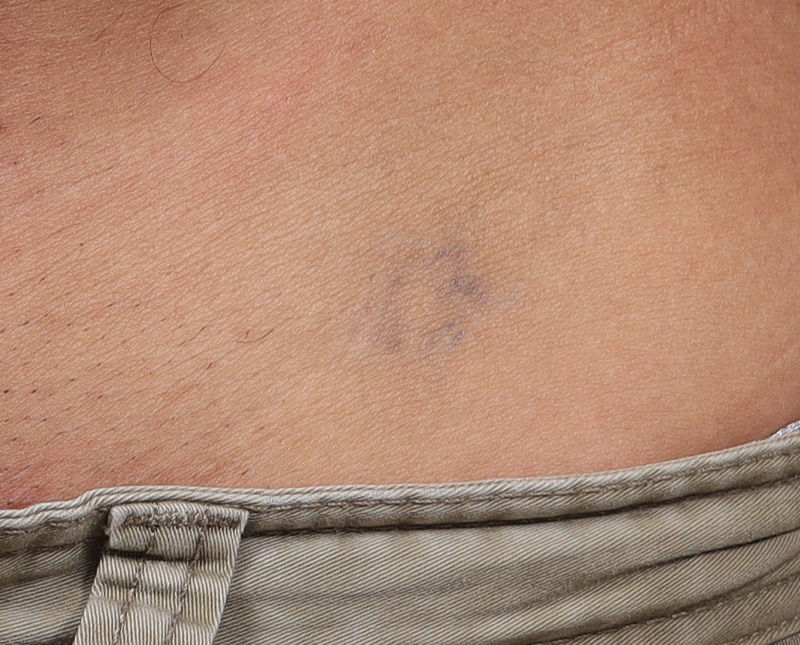 Laser Tattoo Removal Before and After | Comprehensive Laser & Aesthetics
