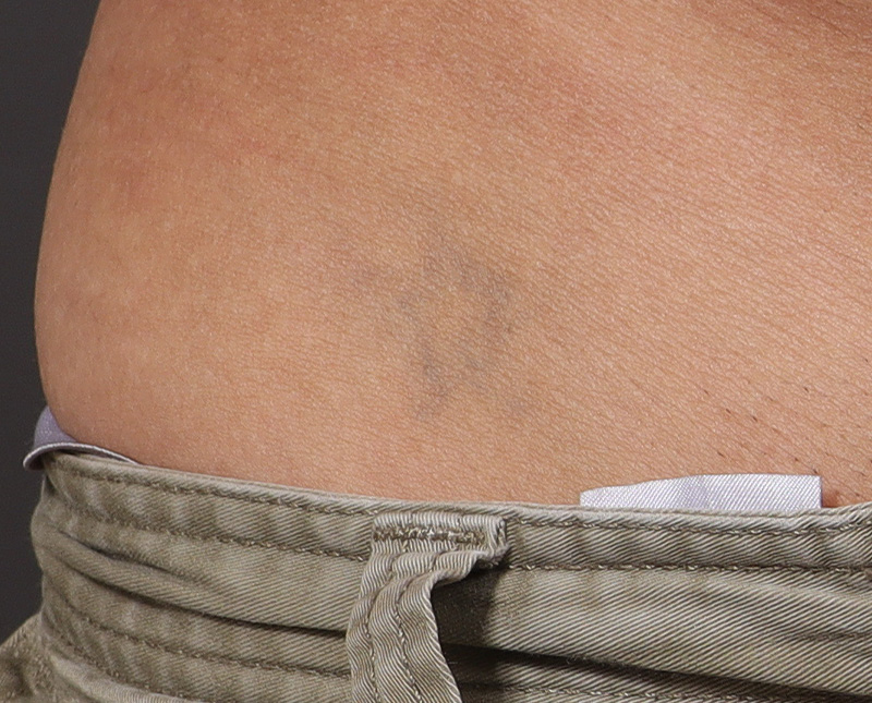 Laser Tattoo Removal Before and After | Comprehensive Laser & Aesthetics