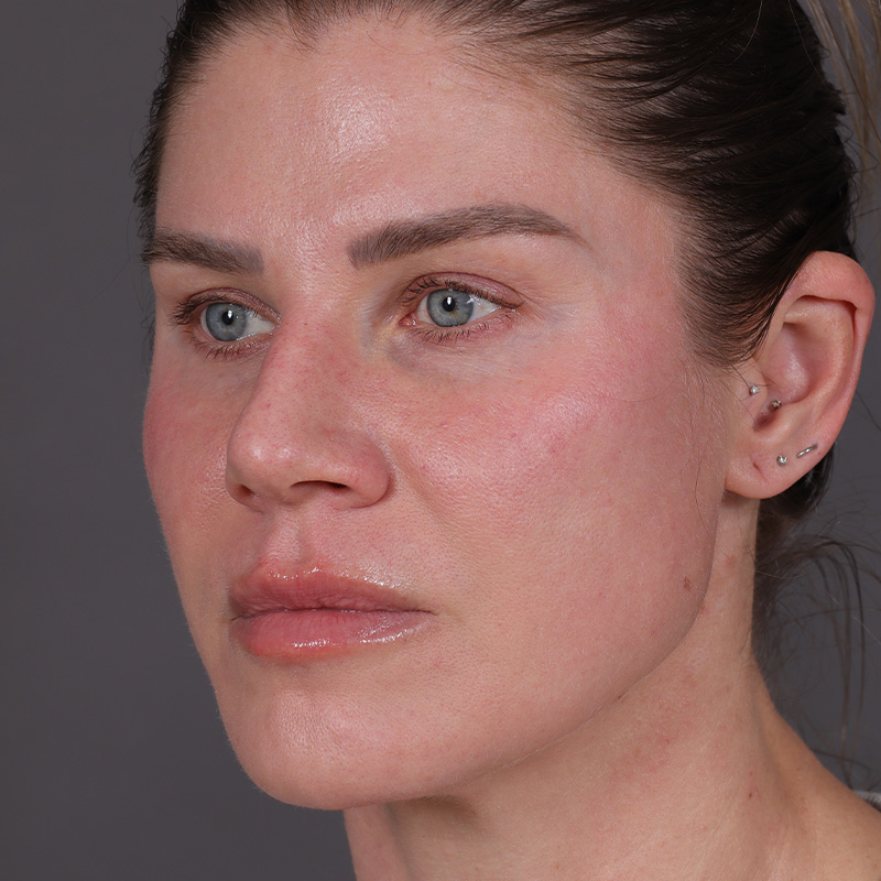 Permanent Makeup Removal Before and After | Comprehensive Laser & Aesthetics