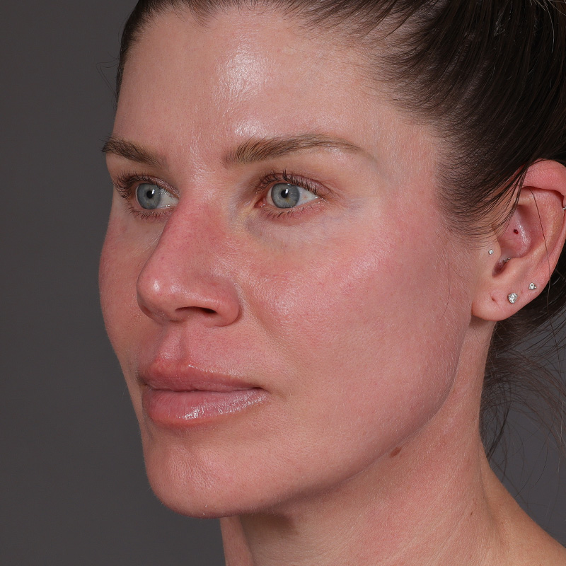 Permanent Makeup Removal Before and After | Comprehensive Laser & Aesthetics