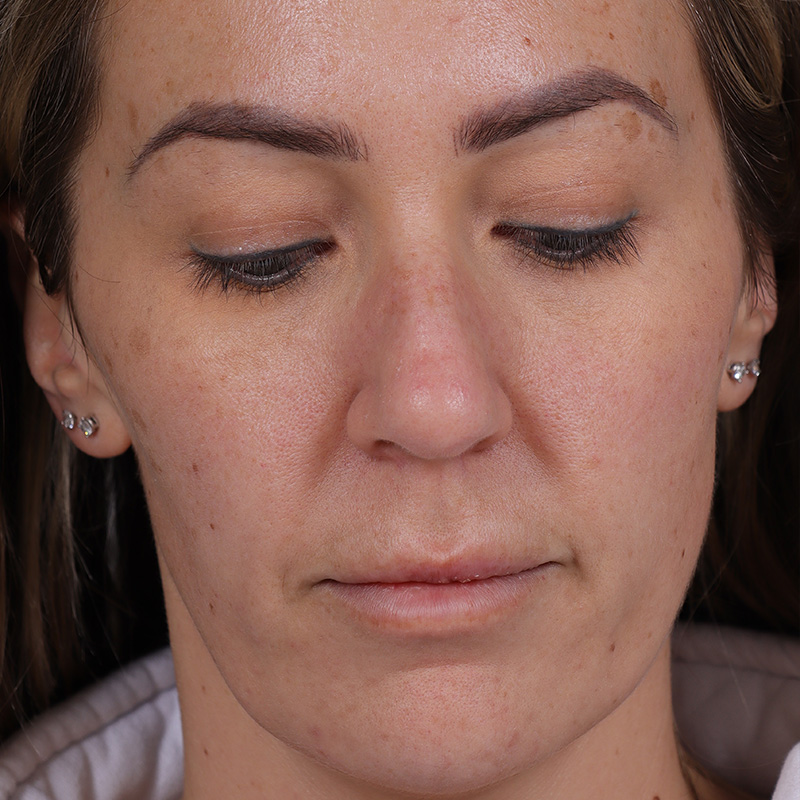 Permanent Makeup Removal Before and After | Comprehensive Laser & Aesthetics