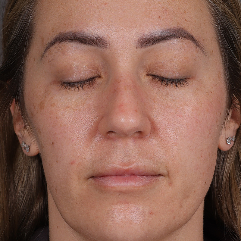 Permanent Makeup Removal Before and After | Comprehensive Laser & Aesthetics