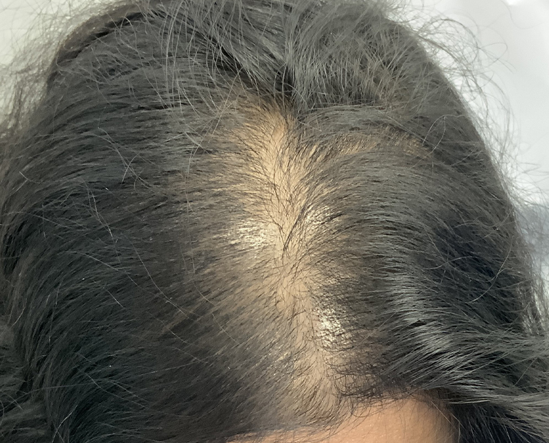 PRP/PRF Before and After | Comprehensive Laser & Aesthetics