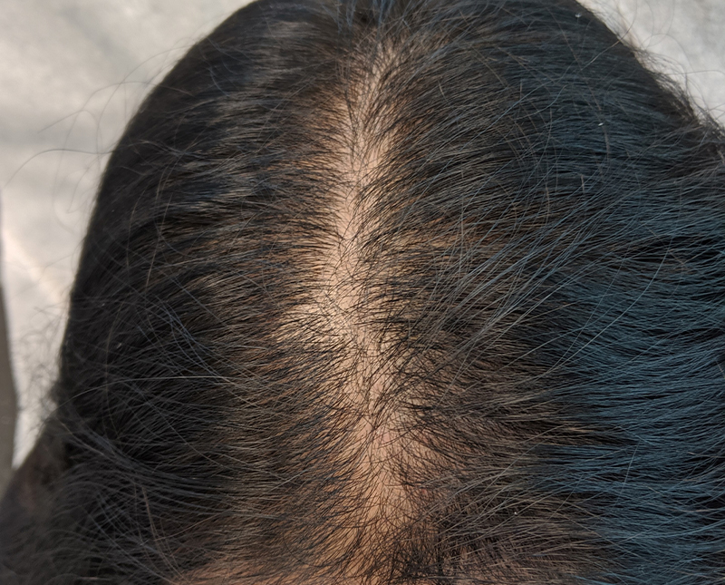 PRP/PRF Before and After | Comprehensive Laser & Aesthetics