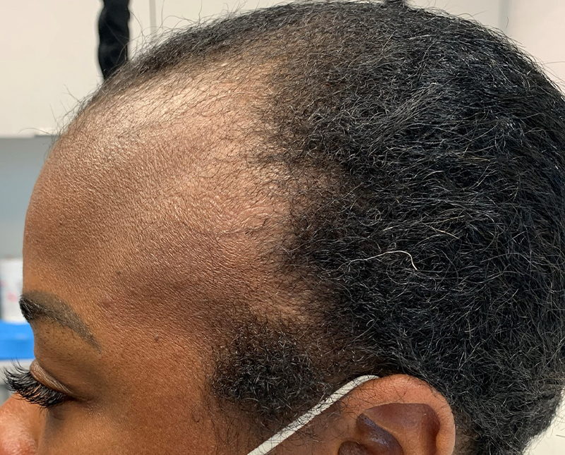 PRP/PRF Before and After | Comprehensive Laser & Aesthetics