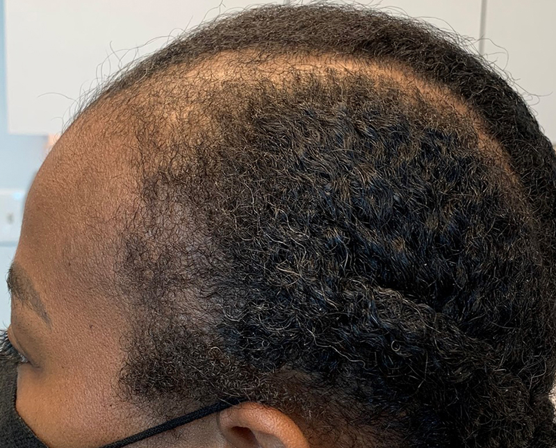 PRP/PRF Before and After | Comprehensive Laser & Aesthetics