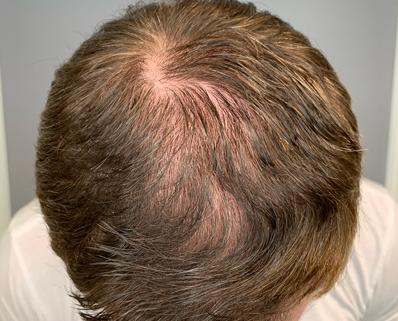 PRP/PRF Before and After | Comprehensive Laser & Aesthetics