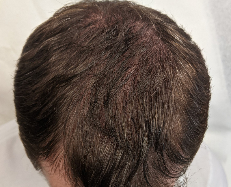 PRP/PRF Before and After | Comprehensive Laser & Aesthetics