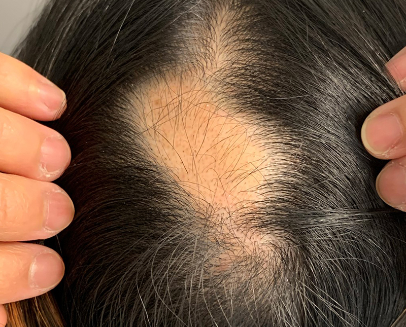 PRP/PRF Before and After | Comprehensive Laser & Aesthetics