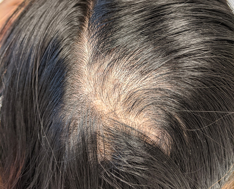 PRP/PRF Before and After | Comprehensive Laser & Aesthetics