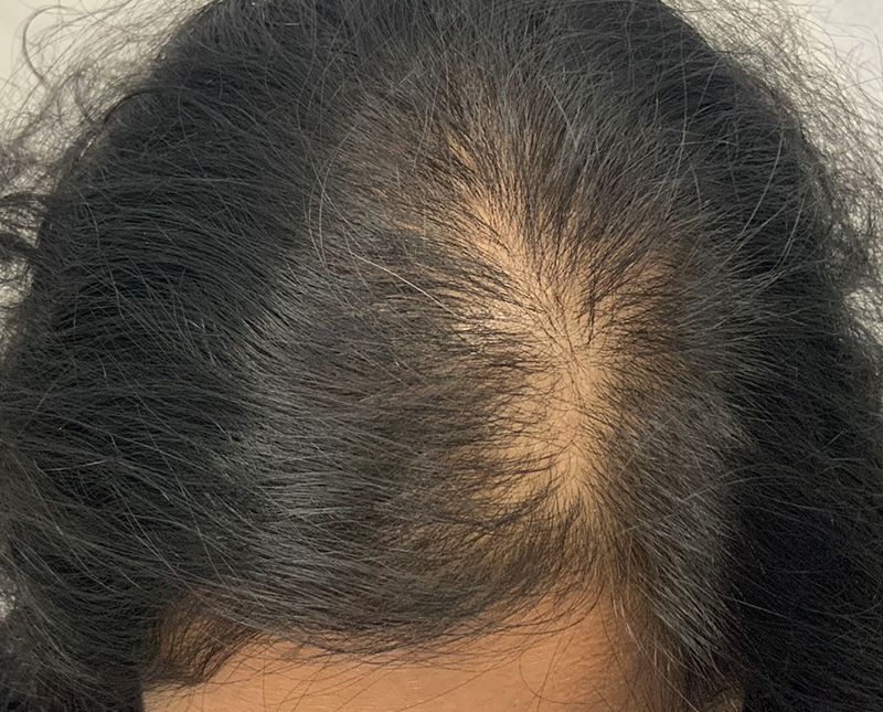 PRP/PRF Before and After | Comprehensive Laser & Aesthetics