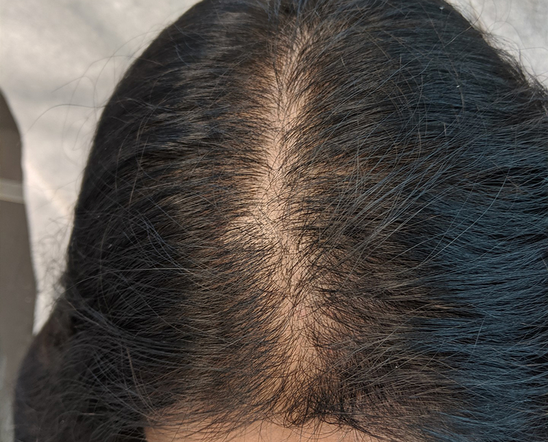 PRP/PRF Before and After | Comprehensive Laser & Aesthetics