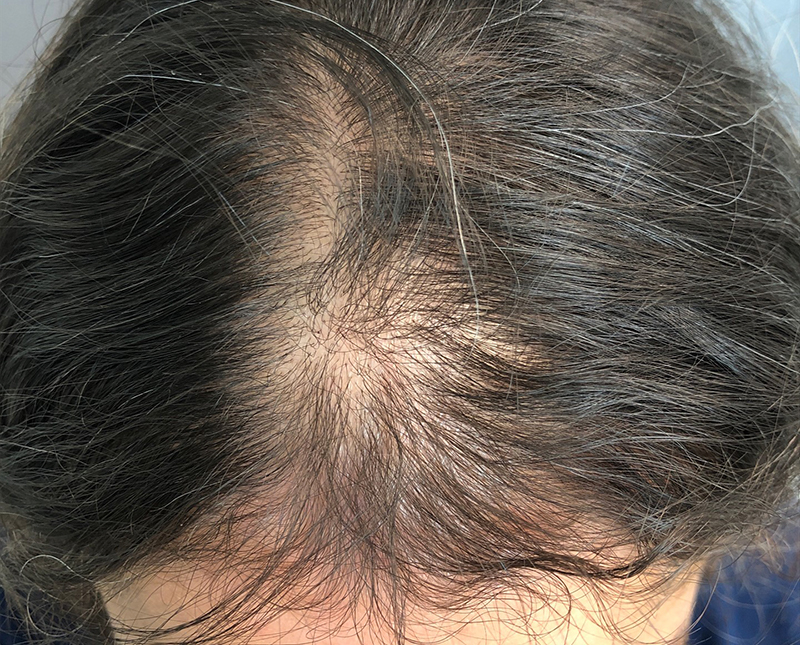 PRP/PRF Before and After | Comprehensive Laser & Aesthetics