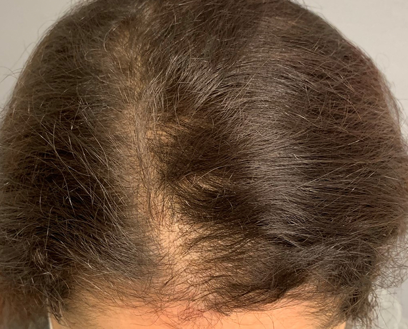 PRP/PRF Before and After | Comprehensive Laser & Aesthetics