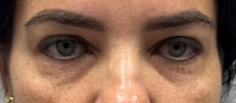 Undereye Rejuvenation Before and After | Comprehensive Laser & Aesthetics
