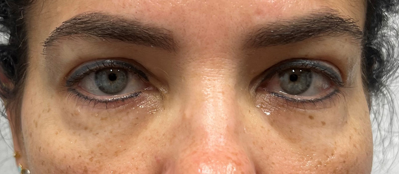 Undereye Rejuvenation Before and After | Comprehensive Laser & Aesthetics