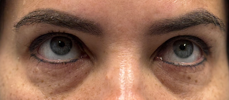 Undereye Rejuvenation Before and After | Comprehensive Laser & Aesthetics