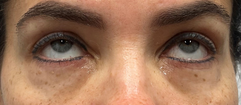 Undereye Rejuvenation Before and After | Comprehensive Laser & Aesthetics