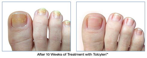 Before And After of Tolcylen Treatment