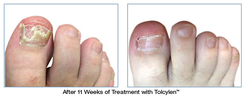 Before And After of Tolcylen Treatment