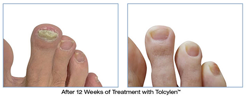 Before And After of Tolcylen Treatment